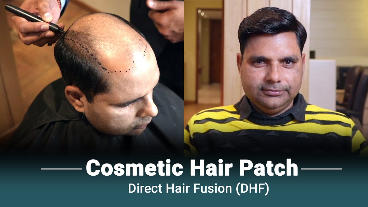 Non-Surgical Hair Loss Solution 👦🏻 |  DHI Cosmetic Human Hair Patch | Hair Wig