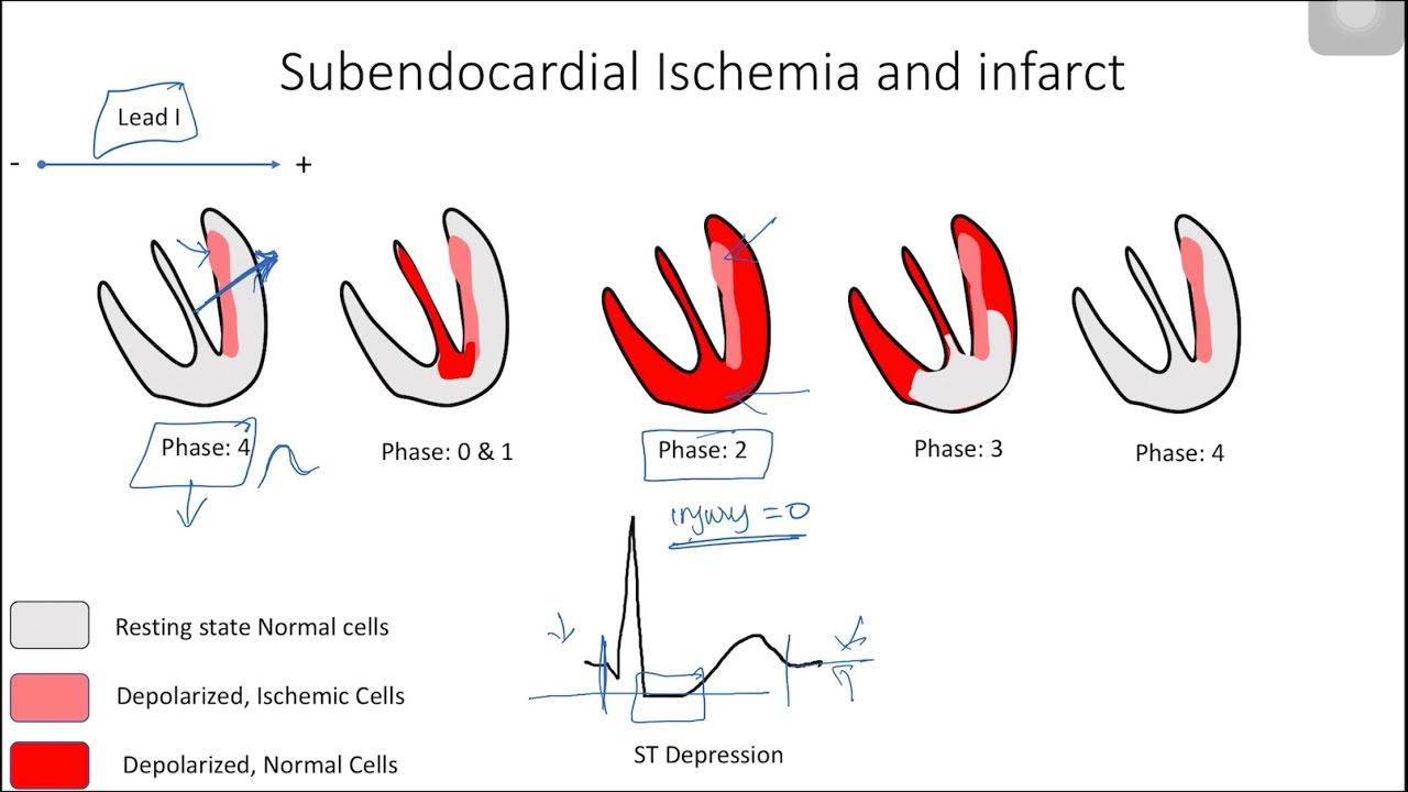 ST Elevation and Depression: Electrophysiological Basis