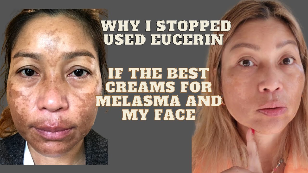 Talking about why I stopped use Eucerin anti-pigment if the cream the best creams for face & melasma