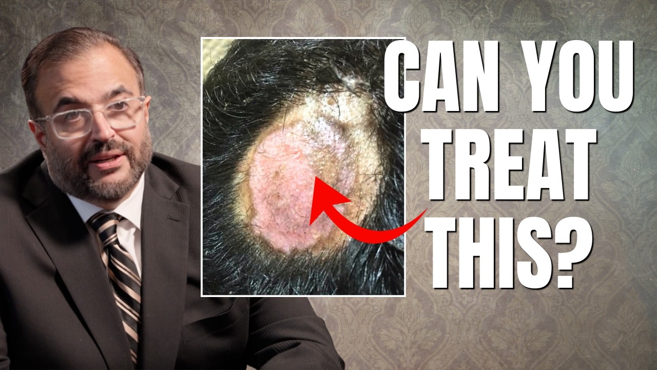 Can Discoid Lupus Cause Permanent Hair Loss?