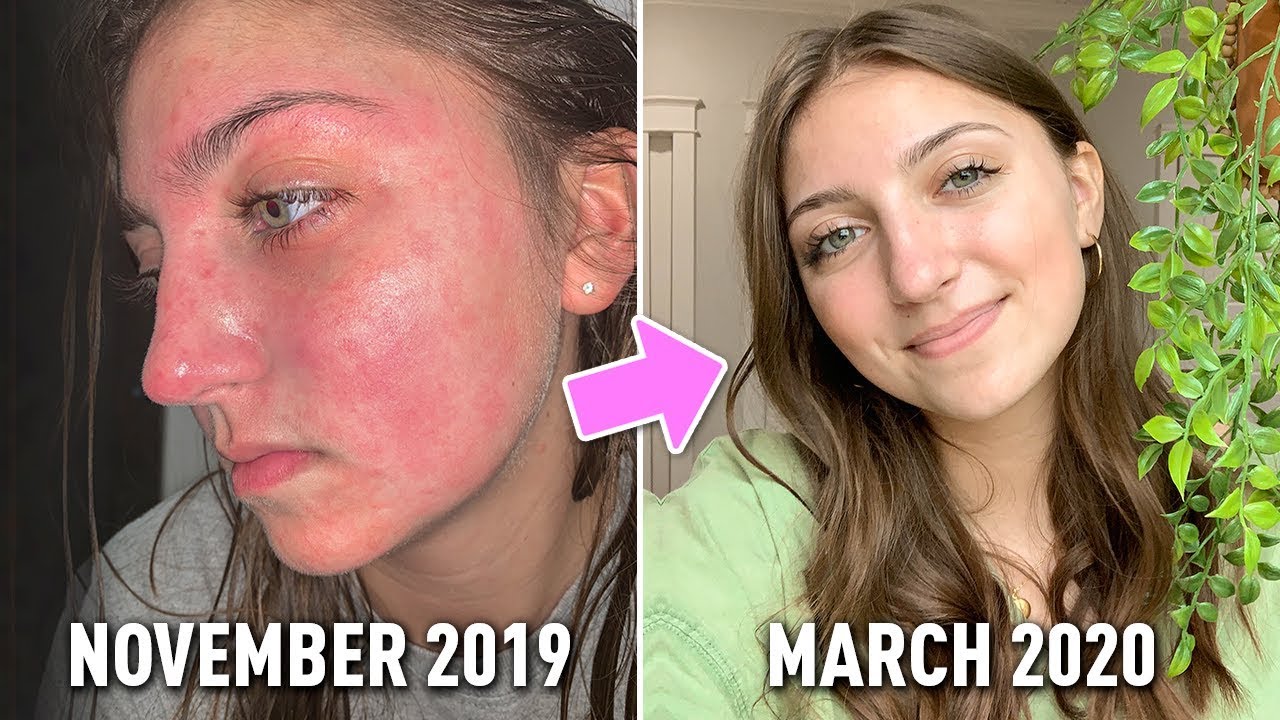 My Clean Skincare Routine *finally clear skin* #WithMe