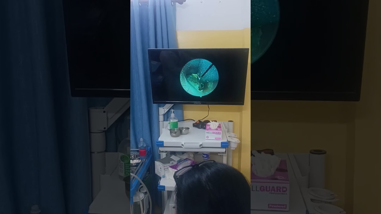 This Wax Blocked All Sound &ndash; Watch It Get Removed! 🔊🧼 #HearingRestored #ENTDoctor