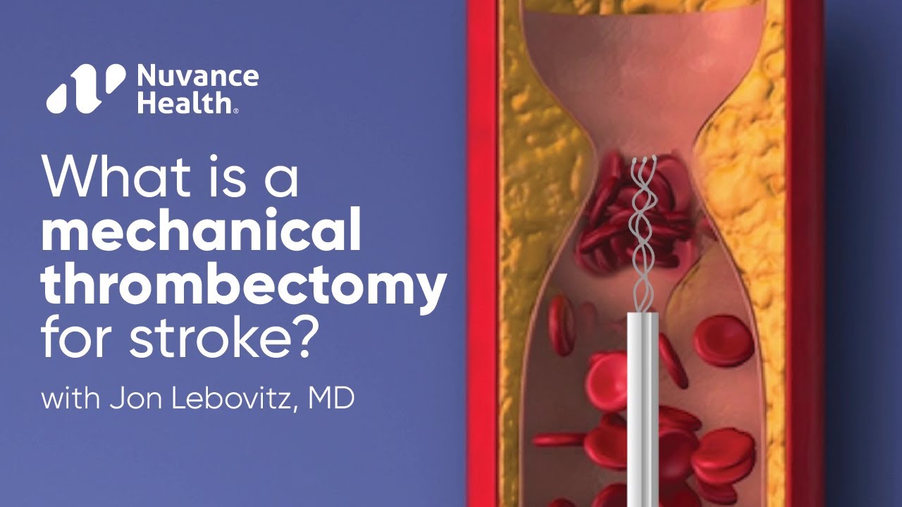What is a Mechanical Thrombectomy for Stroke?