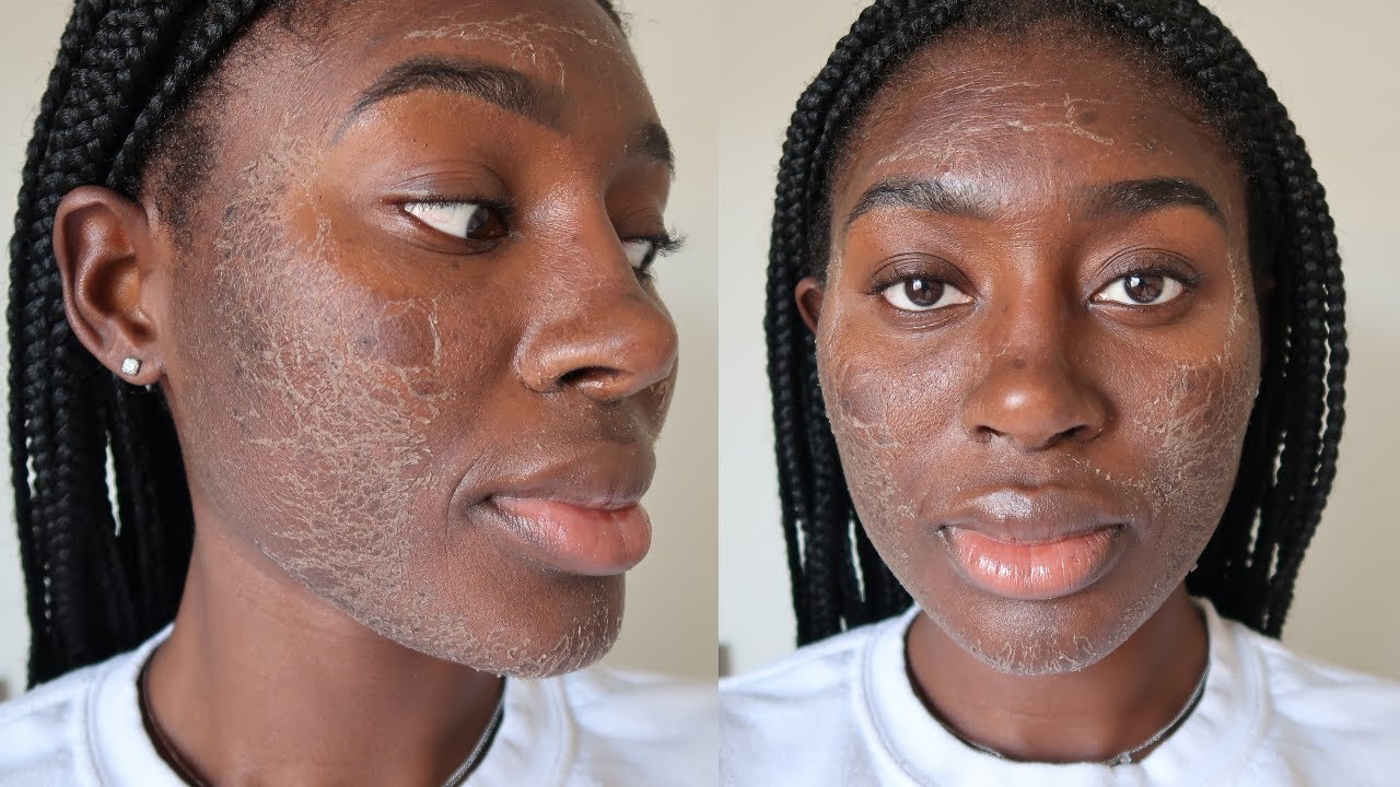 ZENA ALGAE PEEL | REVIEW & RESULTS | BEFORE AND AFTER