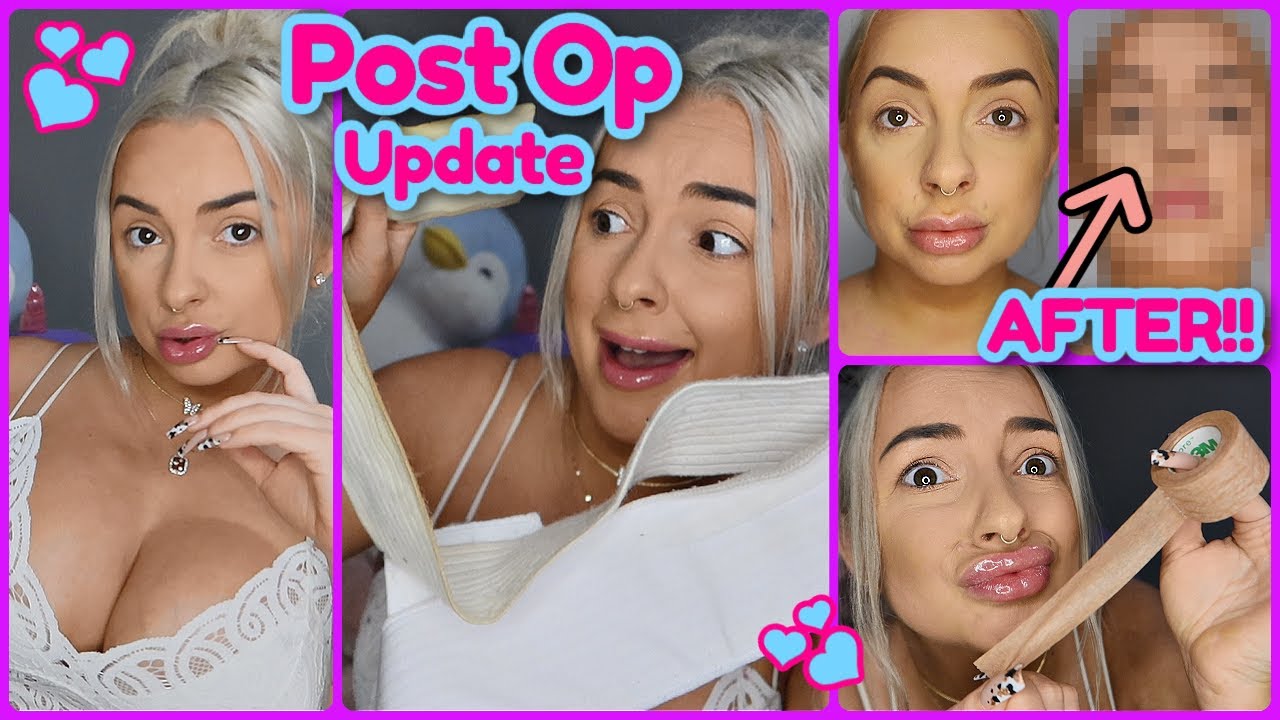 1 Month POST OP | Chin Lipo & Implant Exchange! *UPDATE*
