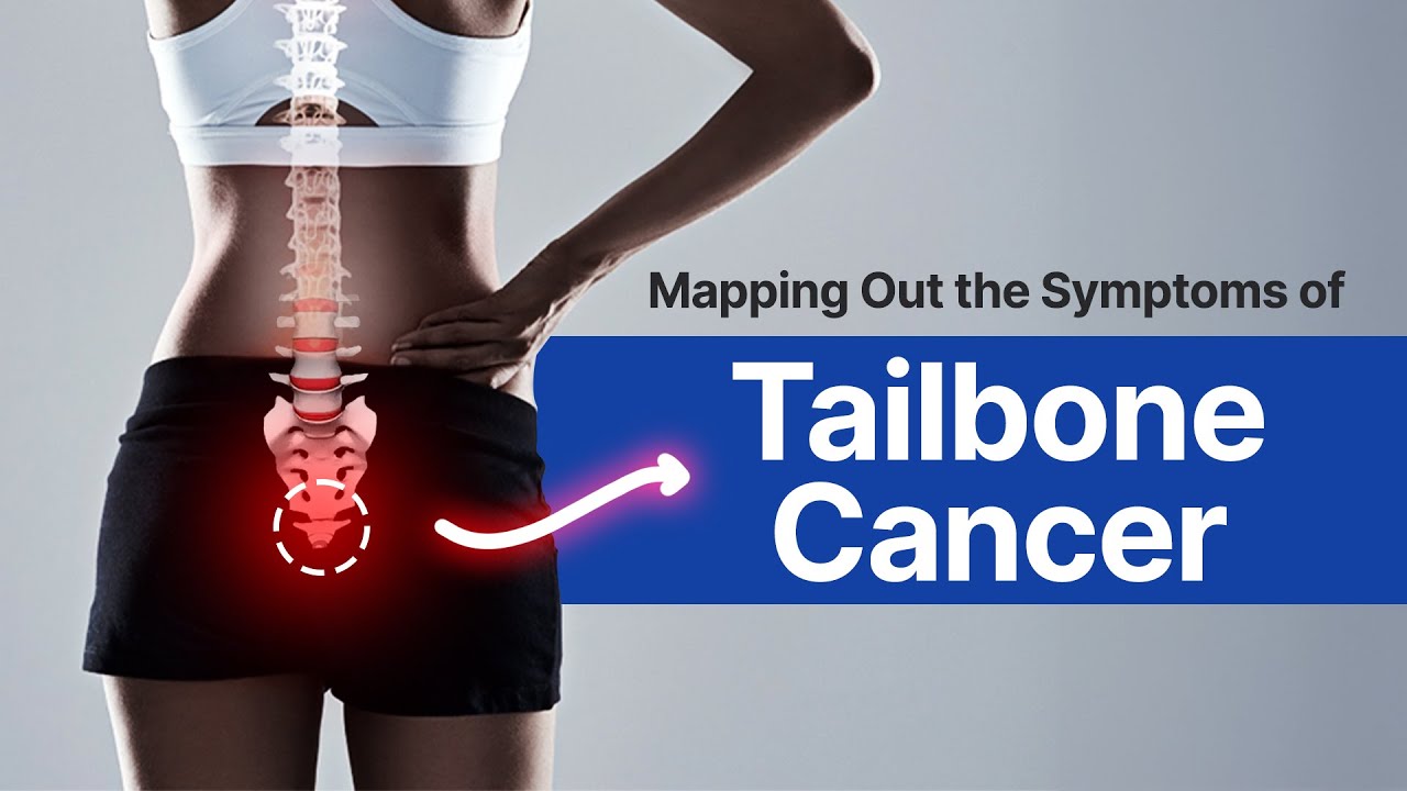 Mapping Out the Symptoms of Tailbone Cancer! | iCliniq