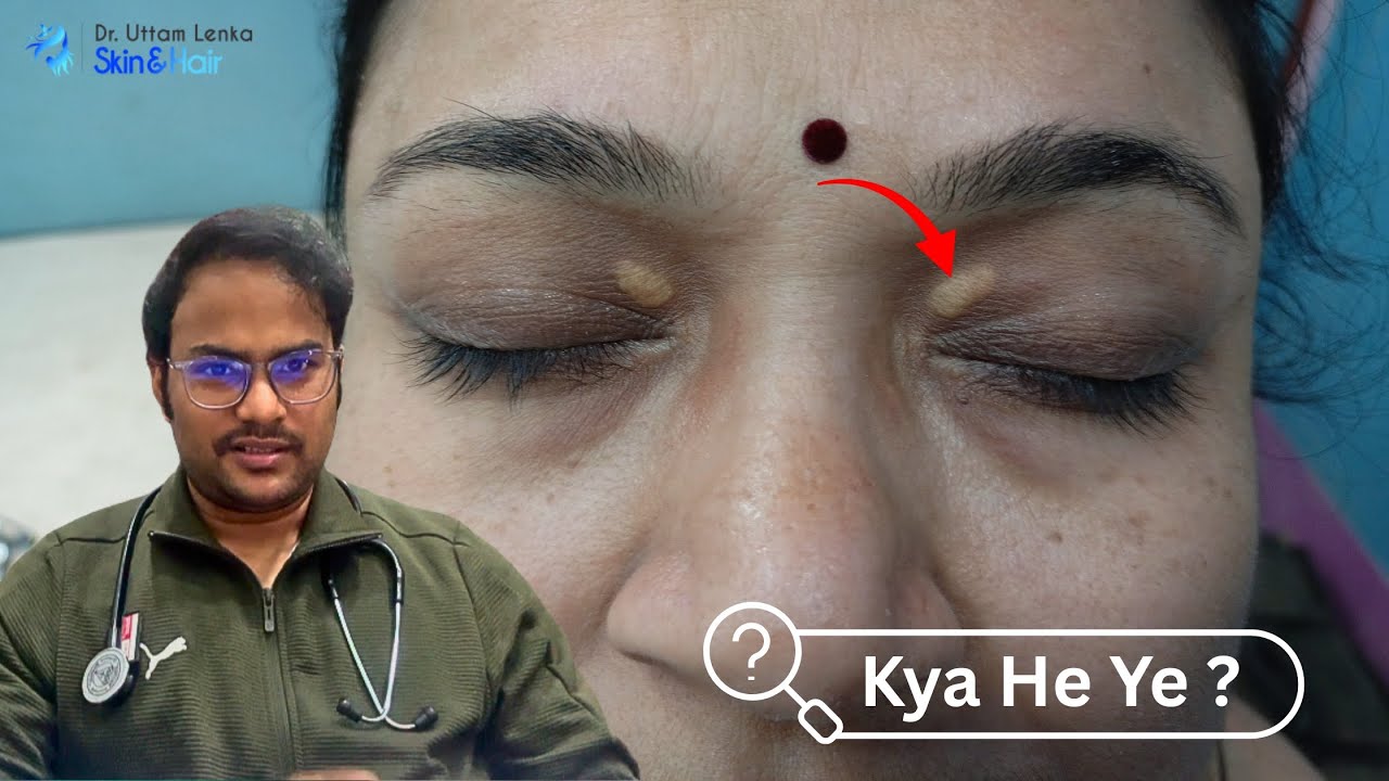  #xanthelasma | yellow colour on eylid | Fat on Eyelid treatment |#skincare #druttamkumarlenka 