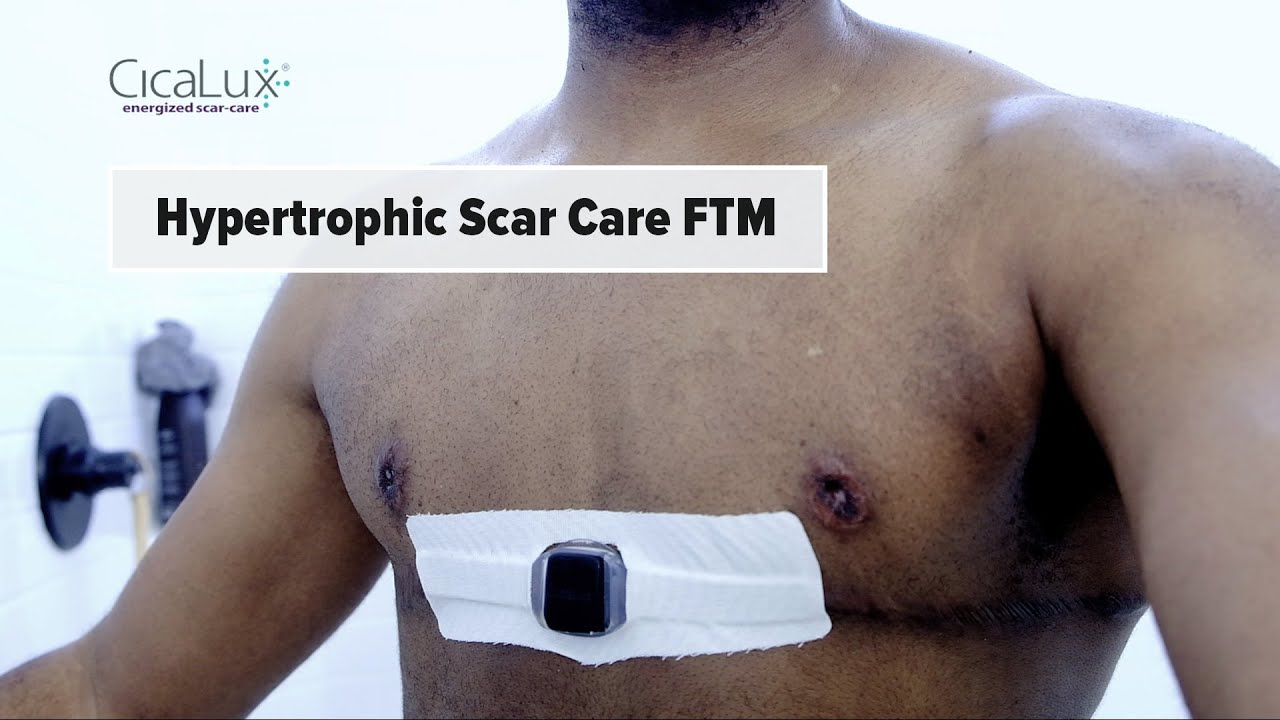 Ftm Top Surgery Hypertrophic Scar Care #cicalux #hrt #masectomy