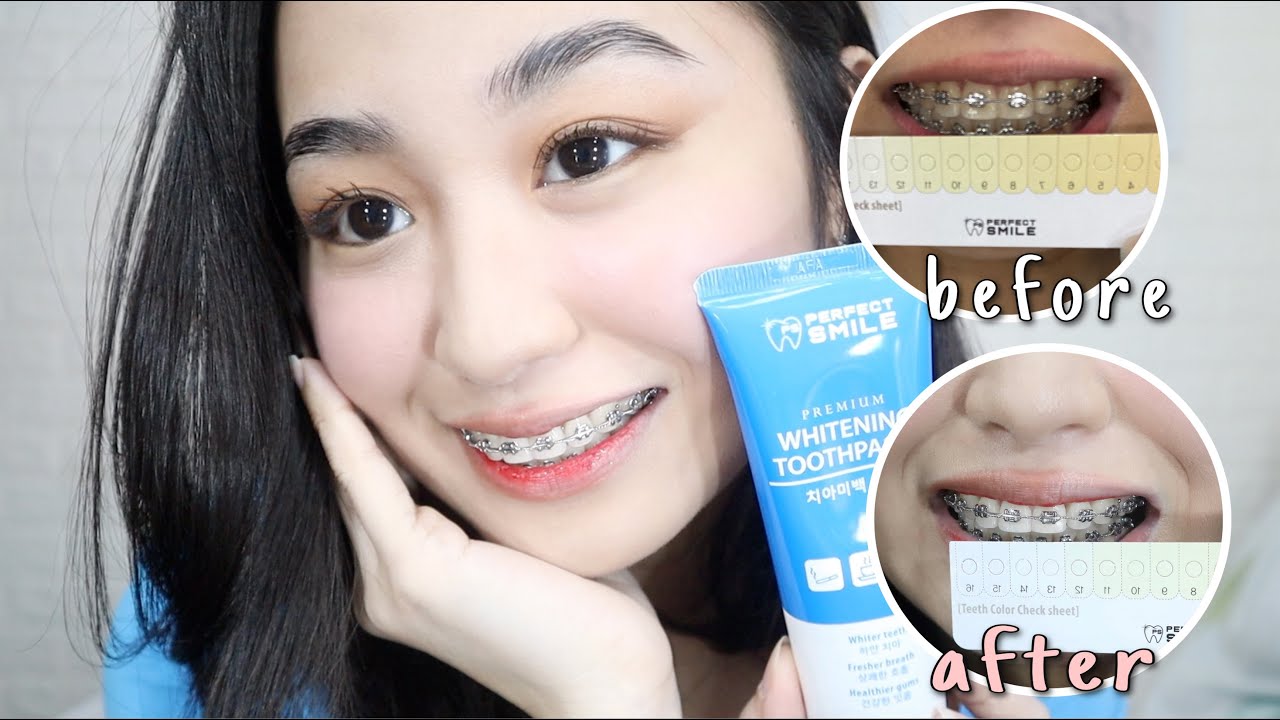 EFFECTIVE AT MURANG PAMPAPUTI NG NGIPIN IN JUST 7 DAYS!! ✨ (FT. Perfect Smile Teeth Whitening)
