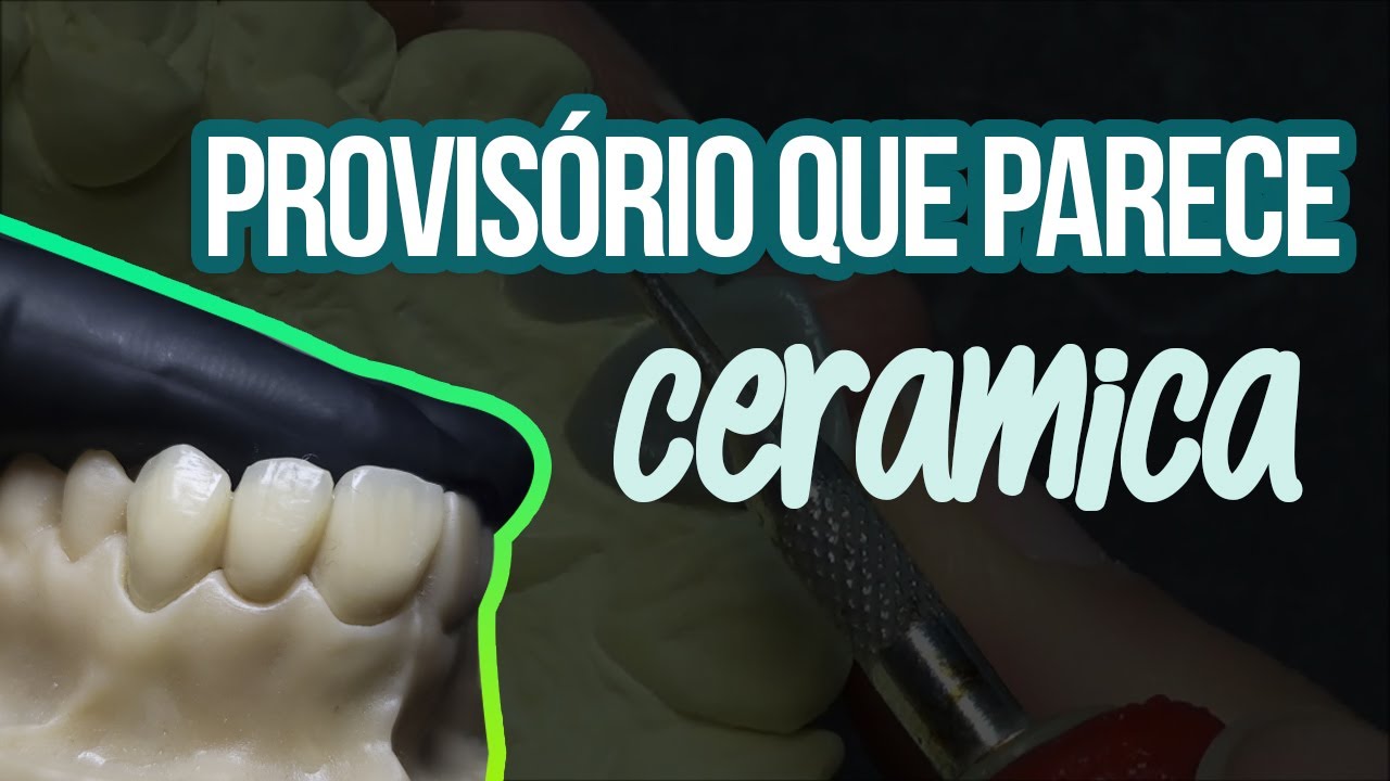 DO PROVISÓRIO À CERÂMICA Ep2 : Como fazer provisório- Dentina+Cut-Back+Incisal+Acabamento [21/22/33]