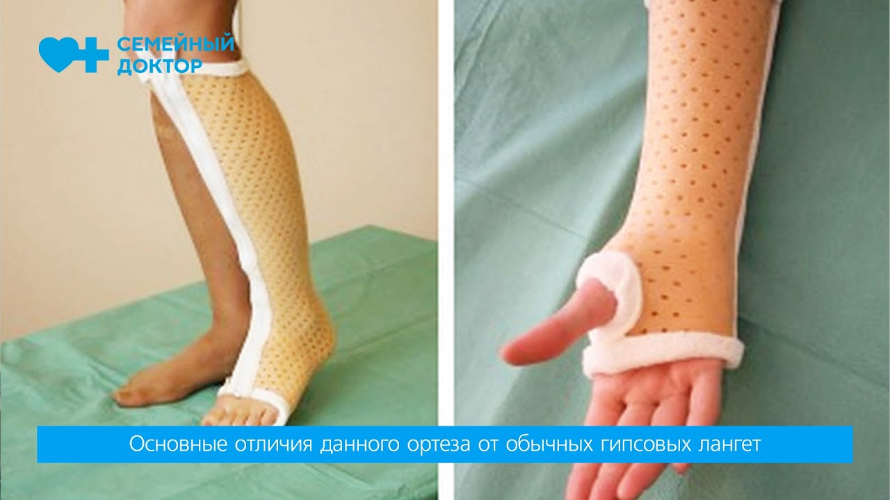 Ортез Турбокаст. Альтернатива традиционным гипсовым фиксаторам при переломах.
