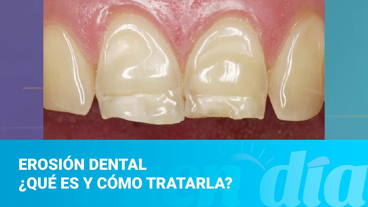 Erosión dental ¿Qué es y cómo tratarla?