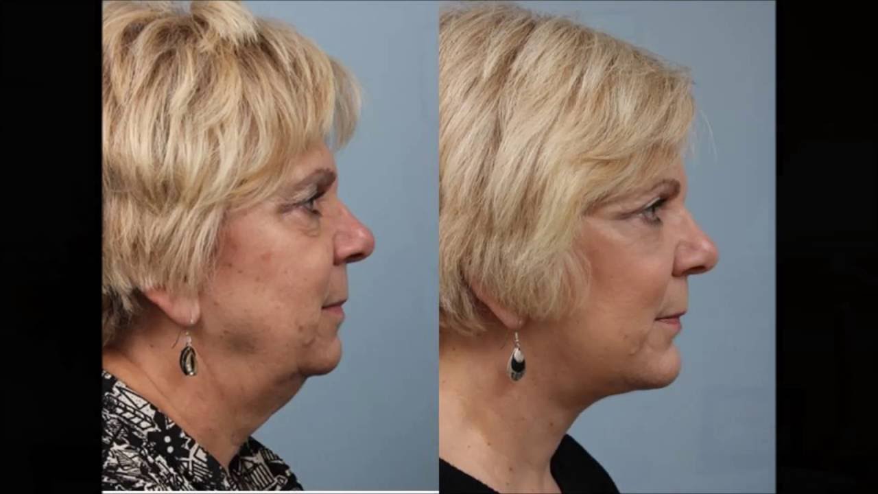 Fireside Chats with Dr. Edwin Williams Best Treatments for a Sagging Neck