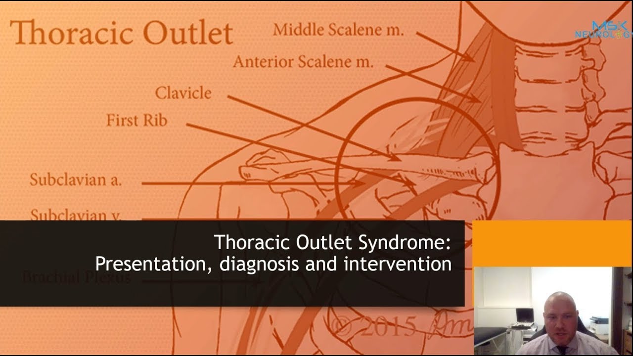 Thoracic outlet syndrome: Presentation, diagnosis & practical intervention