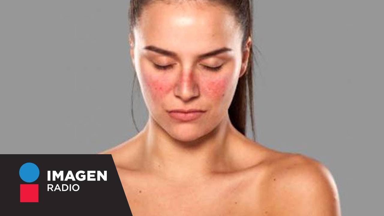 Lupus: Síntomas y causas