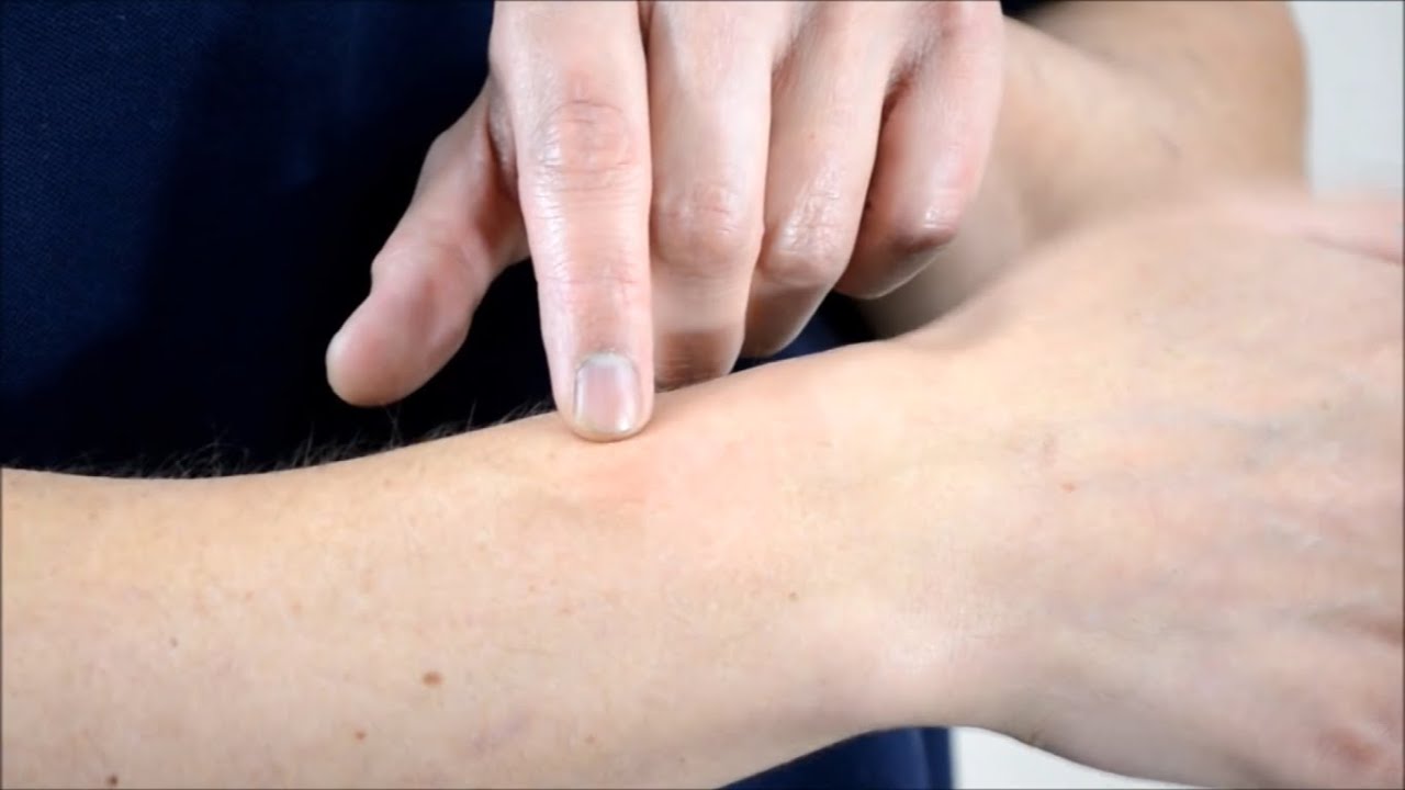 Orthopedic Acupuncture: Radial Wrist Pain
