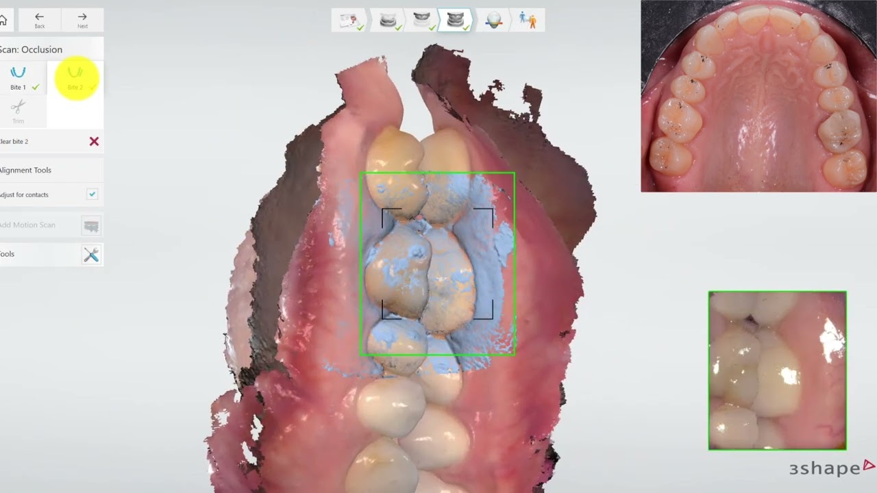 Test rilevazione occlusione statica scanner TRIOS