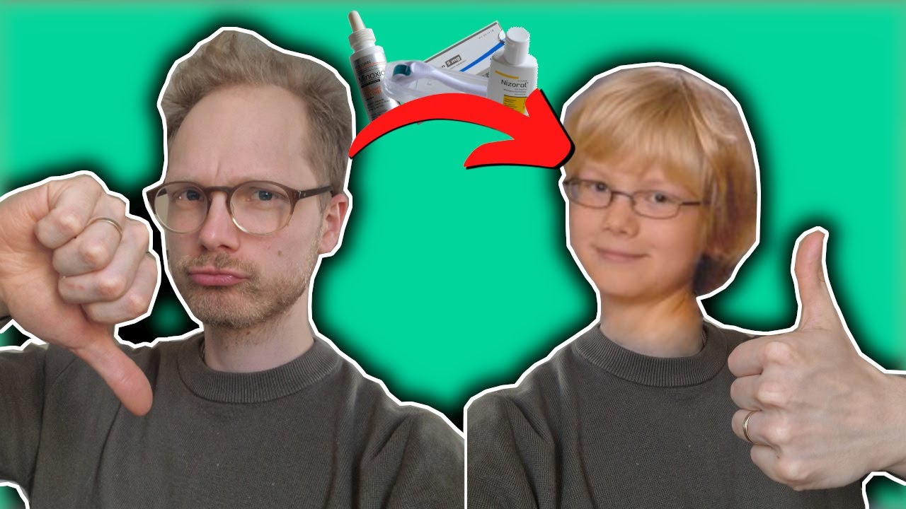 Pystyykö Kaljuuntumisen Pysäyttämään?
