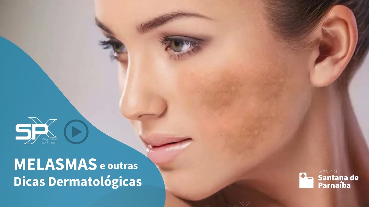 👀 Melasmas e Outras Dicas Dermatol&oacute;gicas 🔍