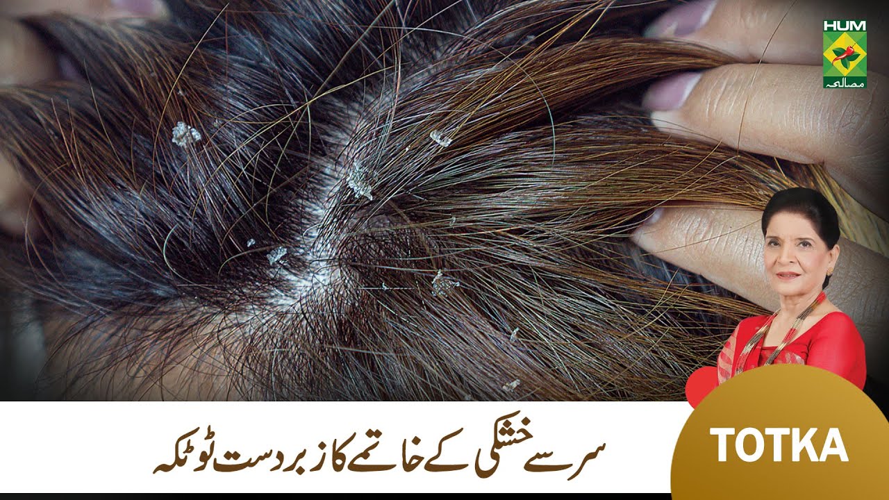 Zubaida Apa Totka | How to Treat Dandruff at Home | Sar ki Khushki Ka Ilaj | Hair Care | MasalaTv