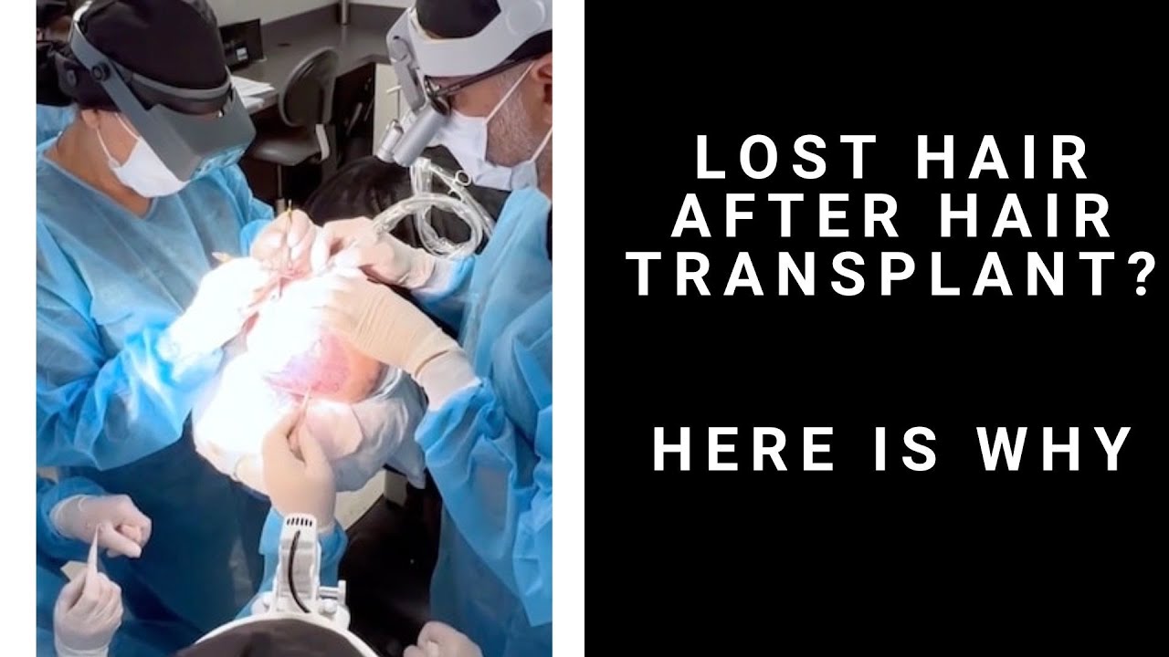 What to do if you are Losing Hair Post FUE Hair Transplant?