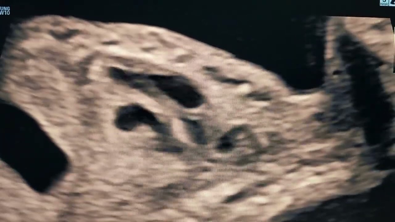 FETAL ECHO DORV FALLOTS TYPE ,DR Pradeep srinivasan- REFER SERIES