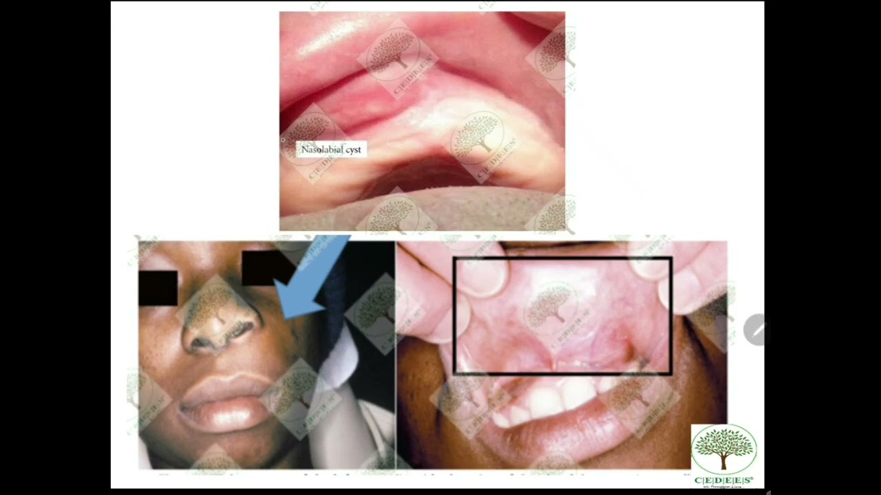 Oral Pathology Doubts - II, Explainer videos