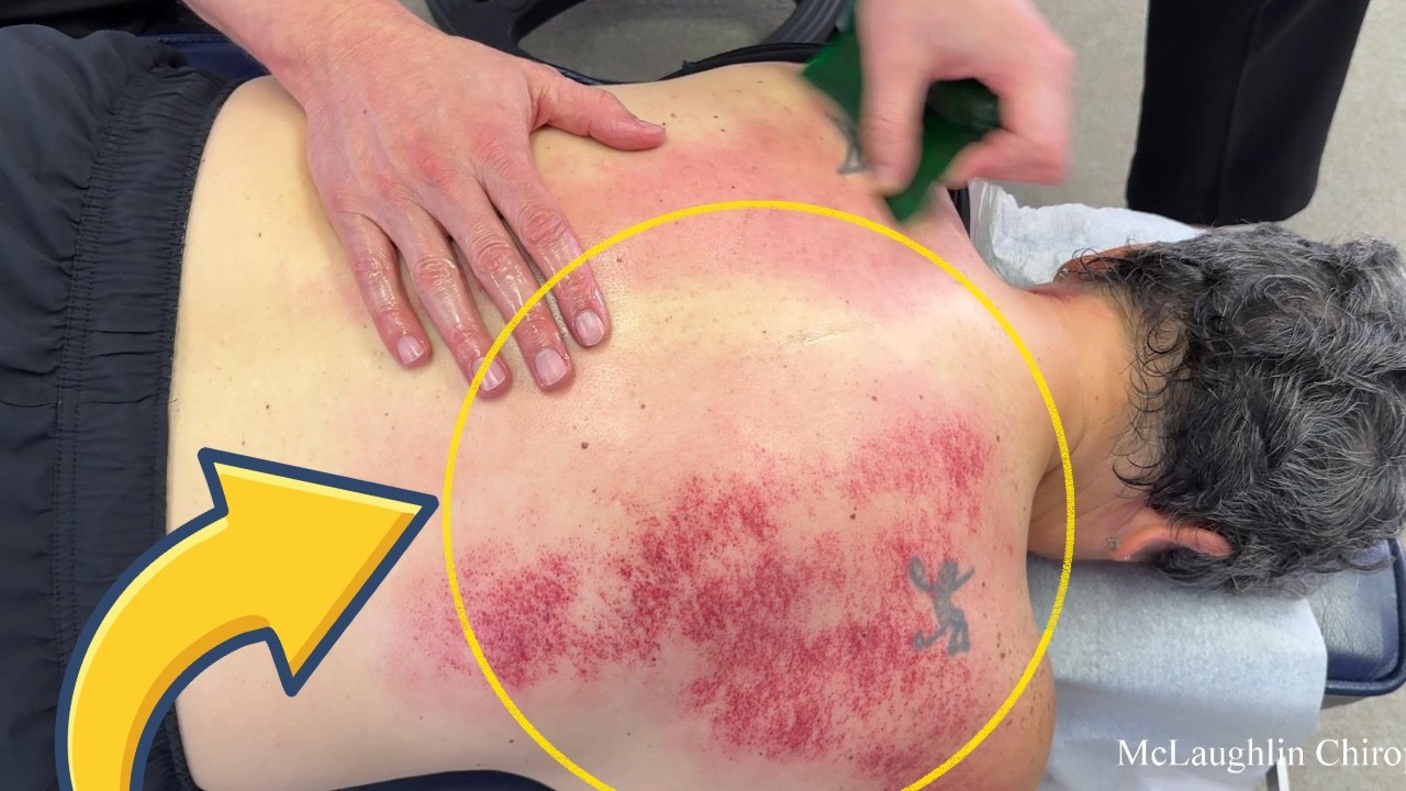 The WORST GUNK Comes Out Of Her Back&Shoulder After A FALL 😱 Incredible Journey To Get WELL | Dr. Ed