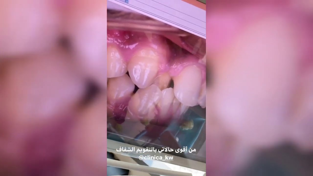 من أقوى حالتي بالتقويم الشفاف | الدكتور محمد نبيل الصافي