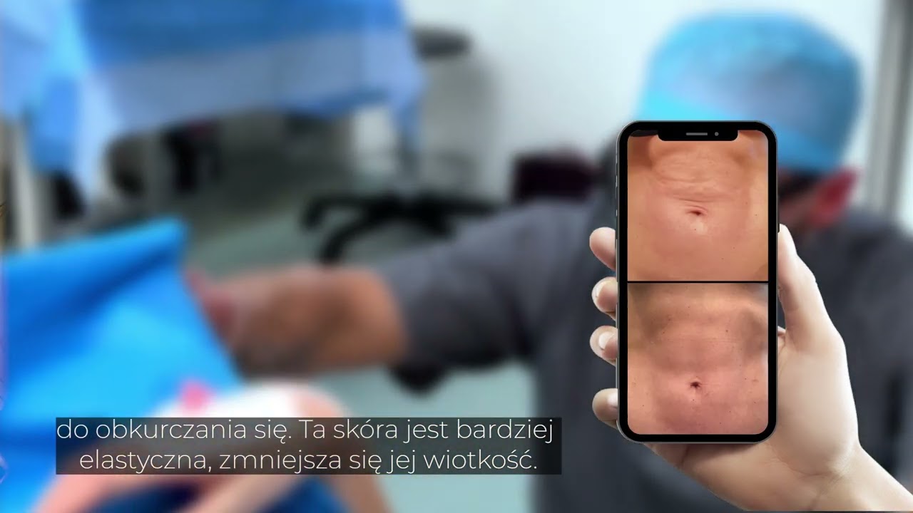 Renuvion - obkurczenie i napięcie wiotkości sk&oacute;ry