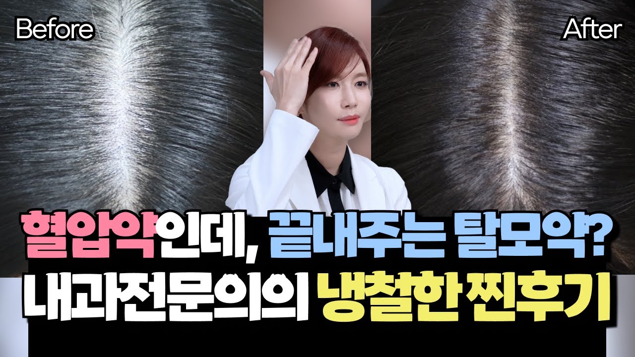 혈압약을 먹었더니 탈모가 치료됐어요. 내과전문의가 직접 복용하고 알려주는 미녹시딜