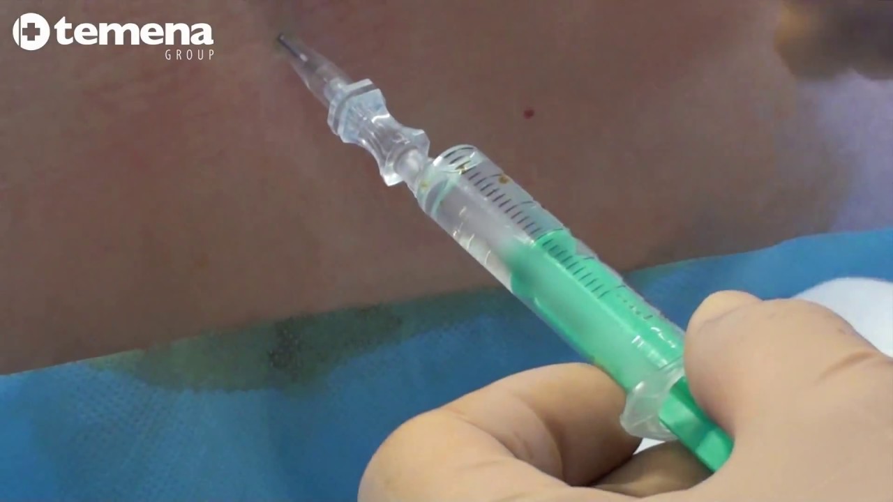 Réalisation d'une rachianesthesie