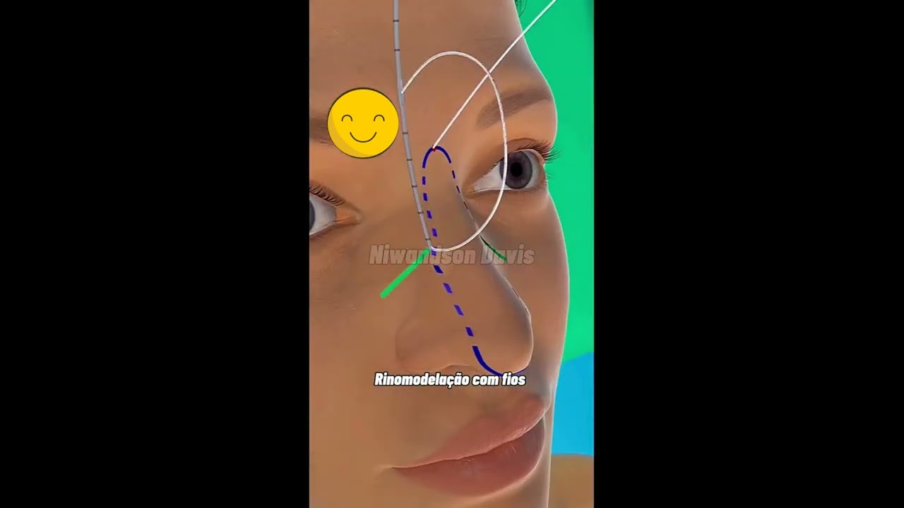 ❤️OLHA COMO &Eacute; FEITA A RINOMODELA&Ccedil;&Atilde;O COM FIOS!!😲💓