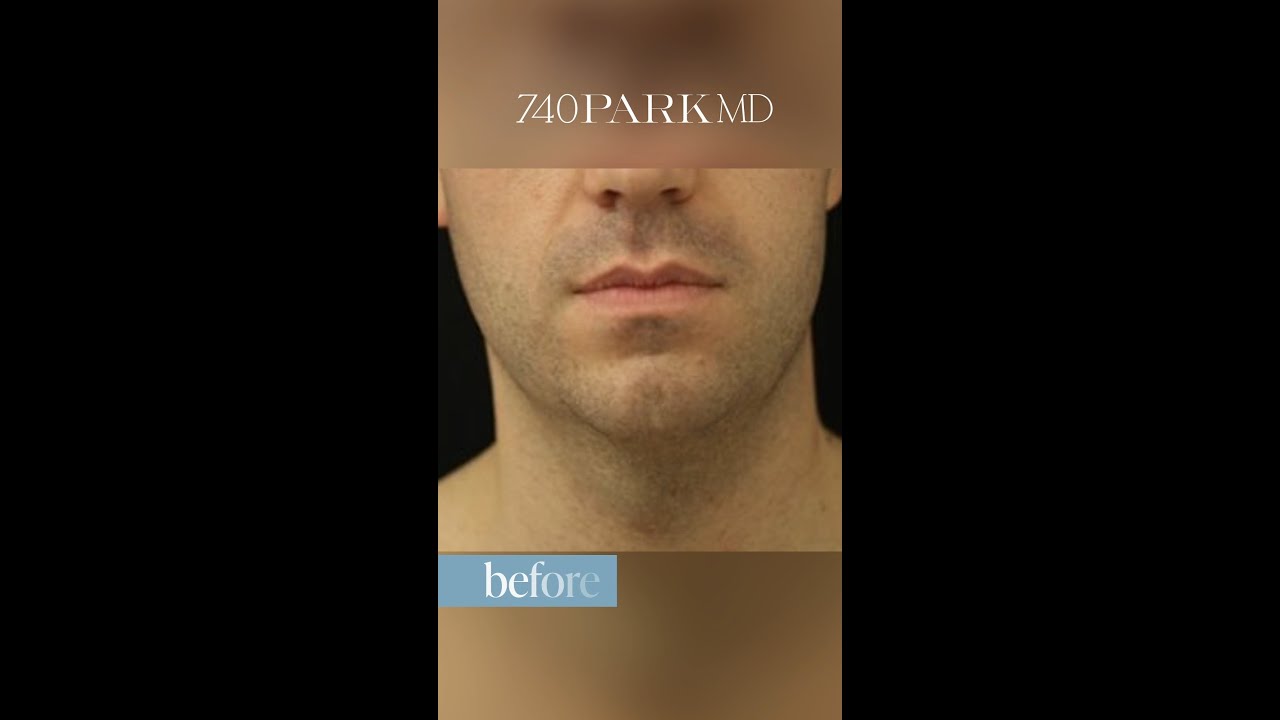 Sculpting a defined neck: A successful liposuction procedure for a male patient.