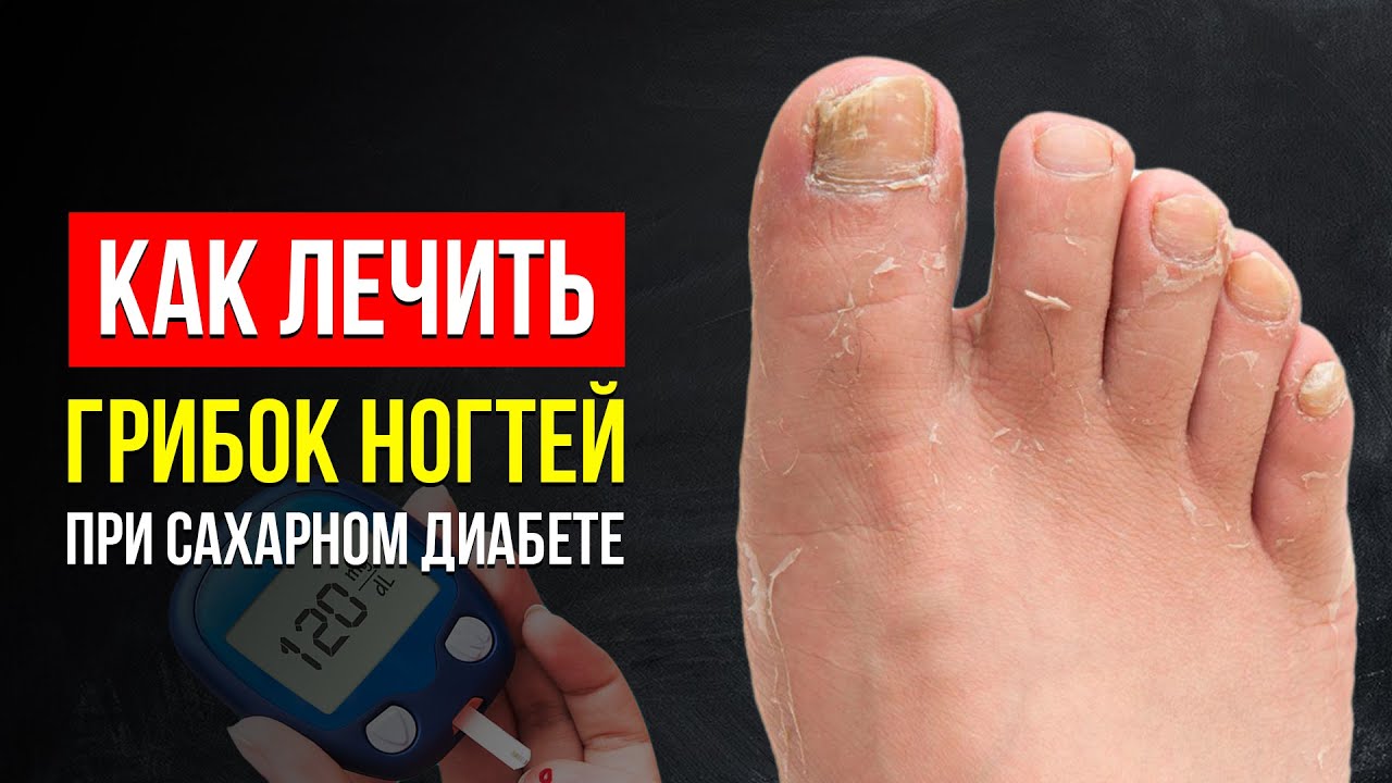Как Лечить ГРИБОК НОГТЕЙ, Если у Вас САХАРНЫЙ ДИАБЕТ? Полезные Советы От Специалиста-Подолога