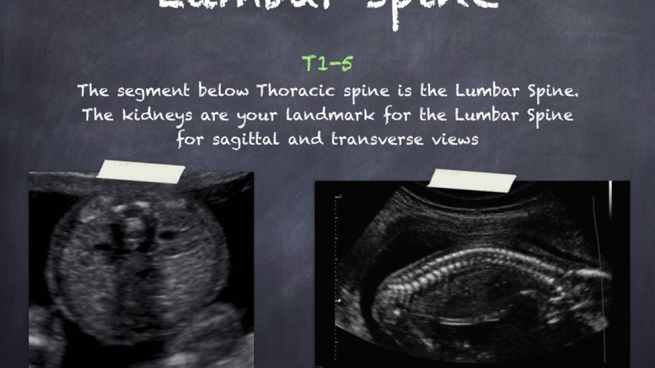 Ultrasound of the Fetal Spine