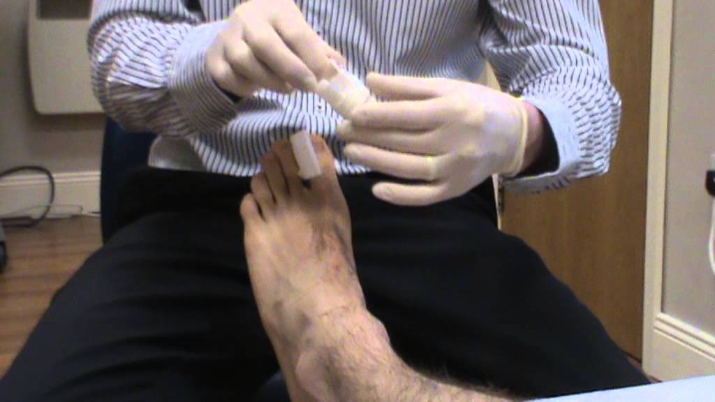 video 35 Toenail Dressing