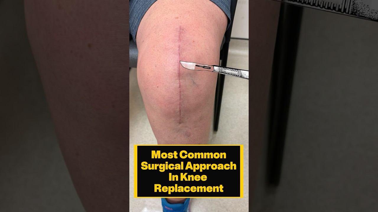 Most Common Surgical Approach in Total Knee Replacement
