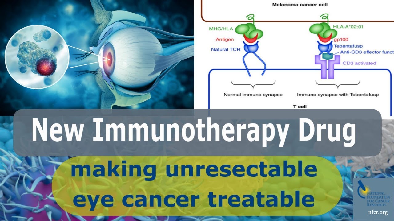 New Immunotherapy Makes Unresectable Eye Cancer Treatable