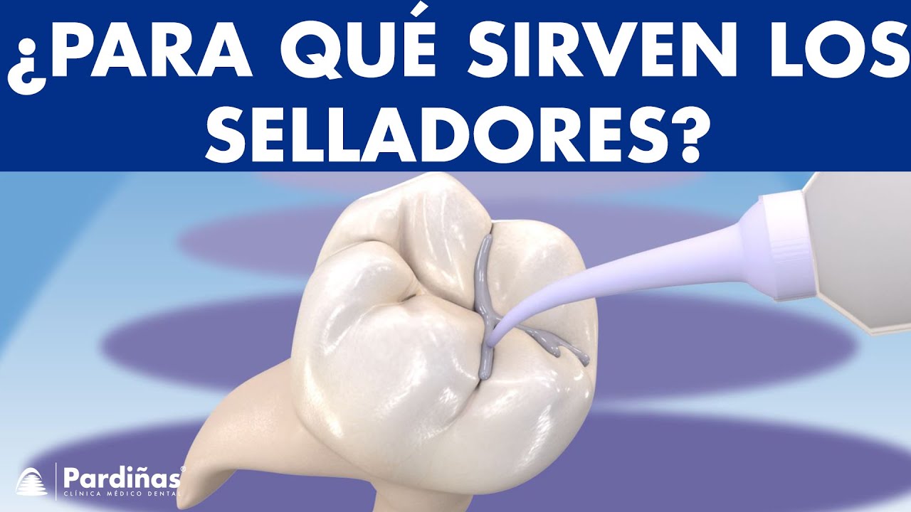 Selladores dentales - Sellado de fosas y fisuras para prevenir caries ©