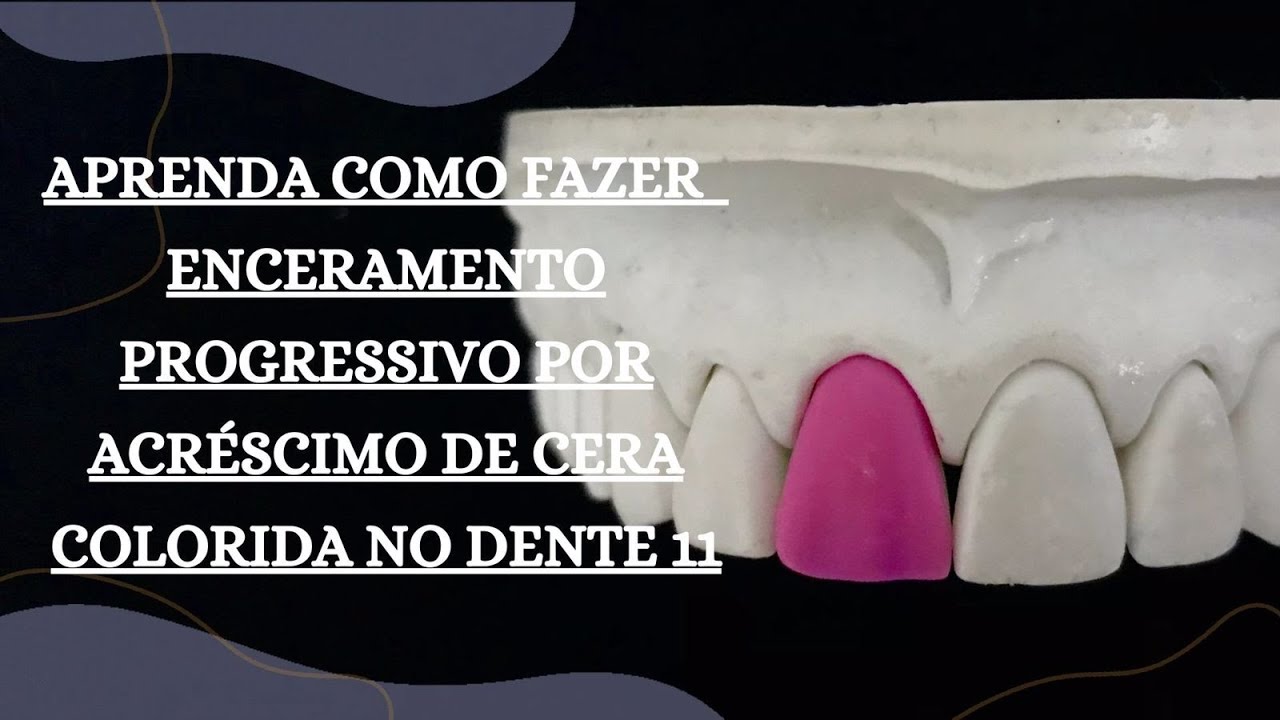 T&eacute;cnica de Enceramento Progressivo por Acr&eacute;scimo de Cera Colorida