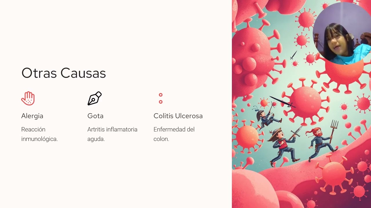 Epiescleritis Inflamacion Ocular 200