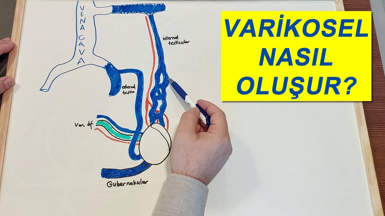 Varikosel Nasıl Oluşur? Nüks Varikoseli Nasıl Tedavi Ediyoruz? 20 Yılı Aşan Tecrübemizle Açıklıyoruz