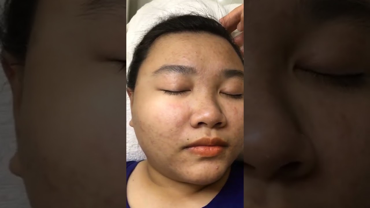 Điều trị mụn nội tiết | Trị mụn Pixel Master | HHV Clinic | Đỗ Thu Hiền | Hiền Vân Spa #shorts