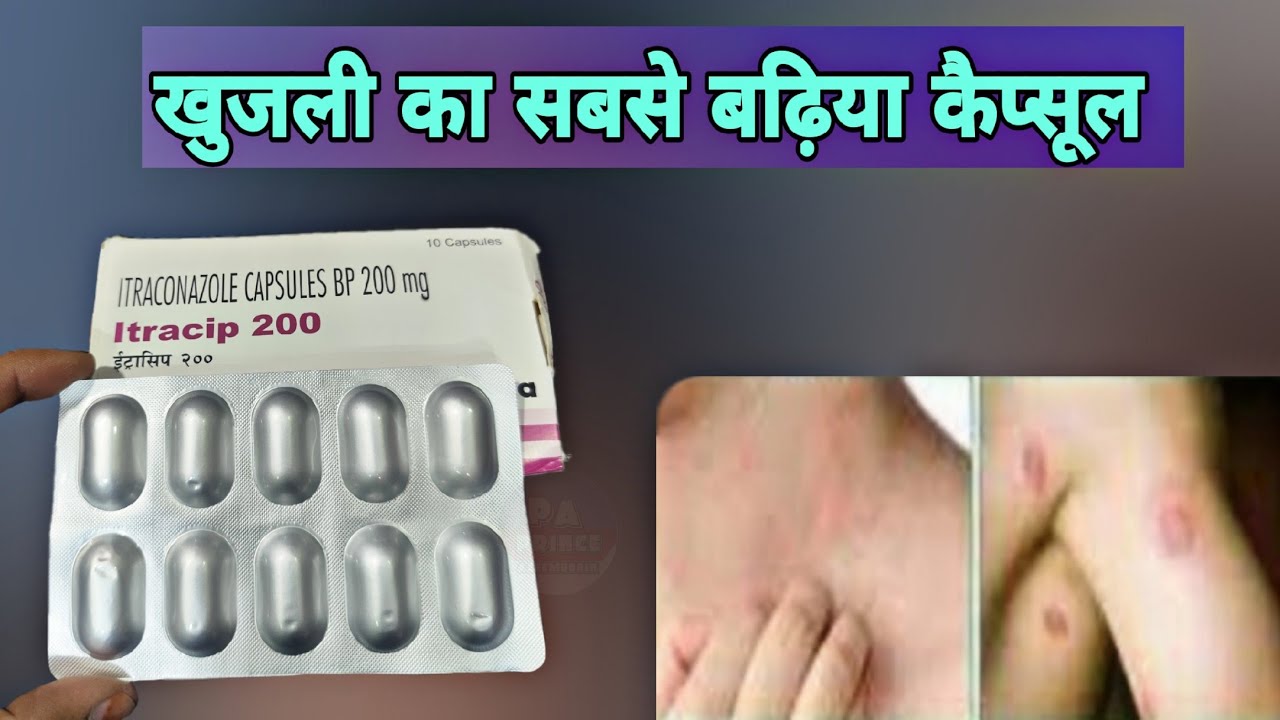 Itraconazole capsules 200 mg | fungal infection capsule | itracip 200 cipla | khujli ki dawai