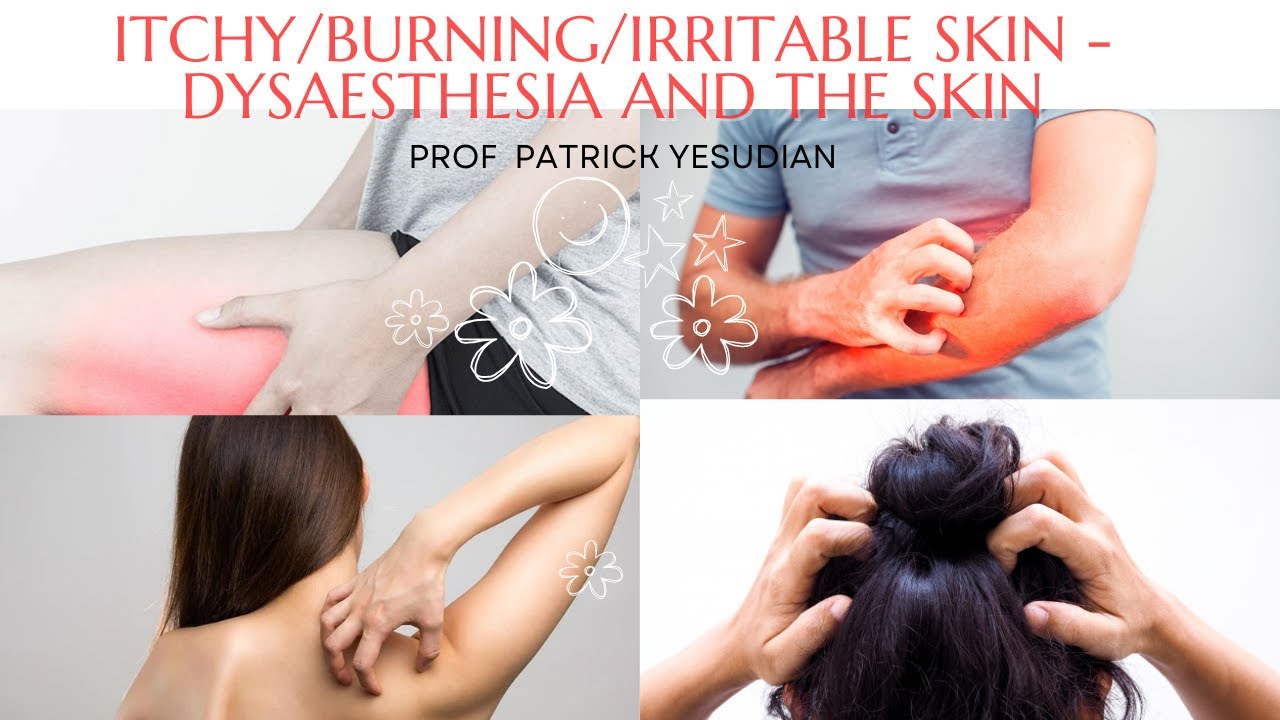 Irritable/Itchy/Burning skin - Dysaesthesia and the skin