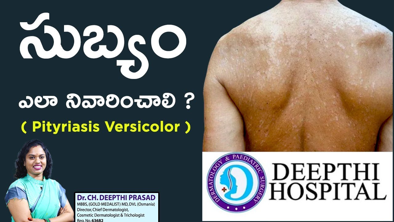 సుబ్యం ఎలా నివారించాలి ? Pityriasis Versicolor | Dr Deepthi Prasad | Karimnagar