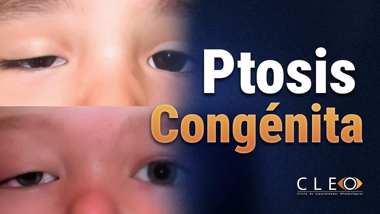 👁️‍🗨️ Todo lo que Debes Saber sobre la Ptosis Congénita: Causas y Tratamientos 🏥✨