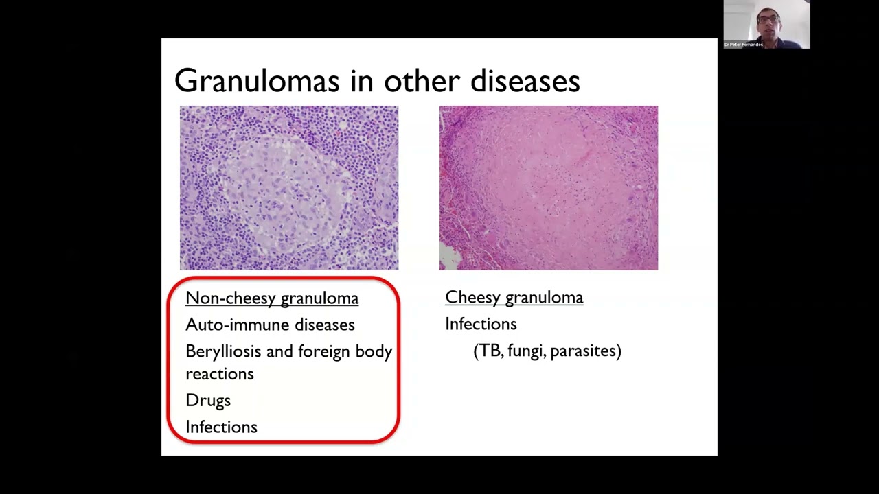 What Causes Sarcoidosis? - Neurosarcoidosis Patient Day 2023