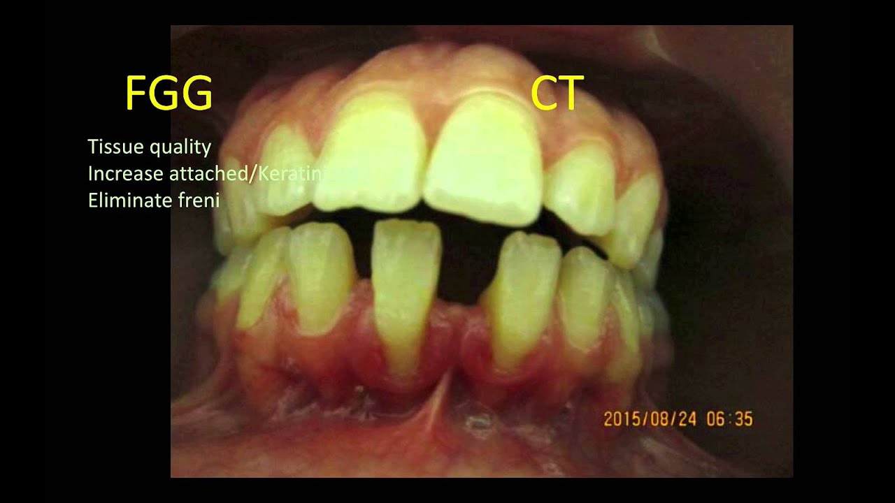 Recession on lower incisors. FGG or CT? (PART 2)
